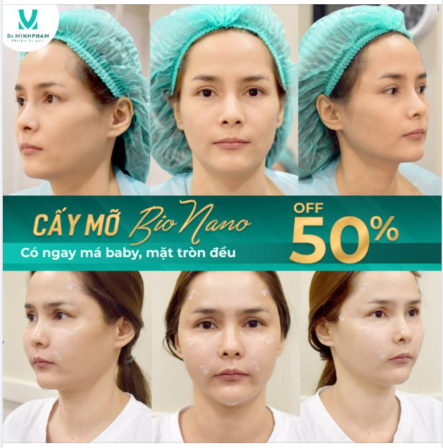 Cấy m.ỡ tự thân là phương pháp trẻ hoá toàn diện khuôn mặt. Dùng m.ỡ được lấy ra từ vùng m.ỡ thừa trên cơ thể khách hàng thay vì dùng các chất làm đầy nhân tạo.
