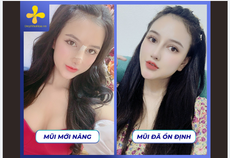CHĂM SÓC SAU NÂNG MŨI MỘT SỐ ĐIỀU BẠN CẦN LƯU Ý