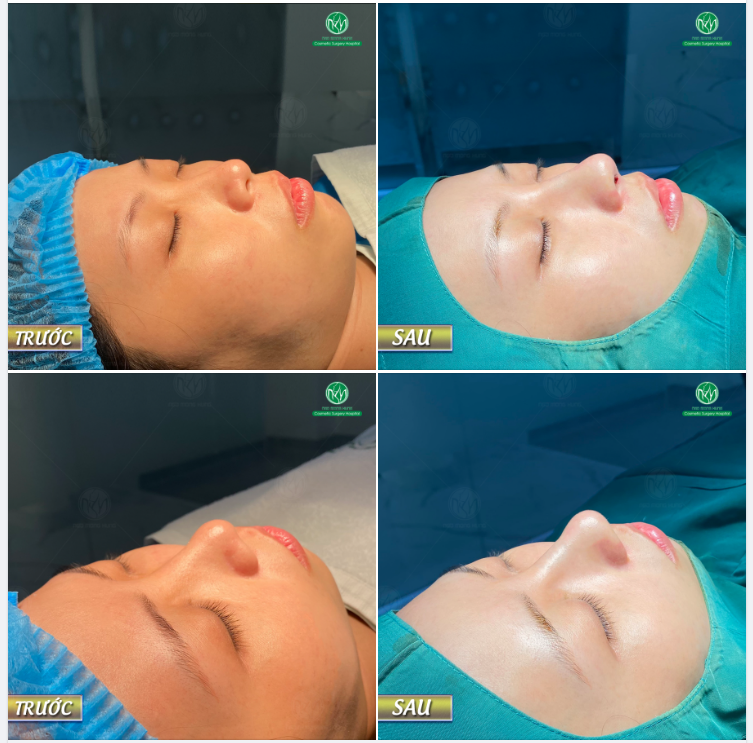 CHÀO NGÀY CHỦ NHẬT VỚI KẾT QUẢ MỘT CA NÂNG MŨI MEGADERM