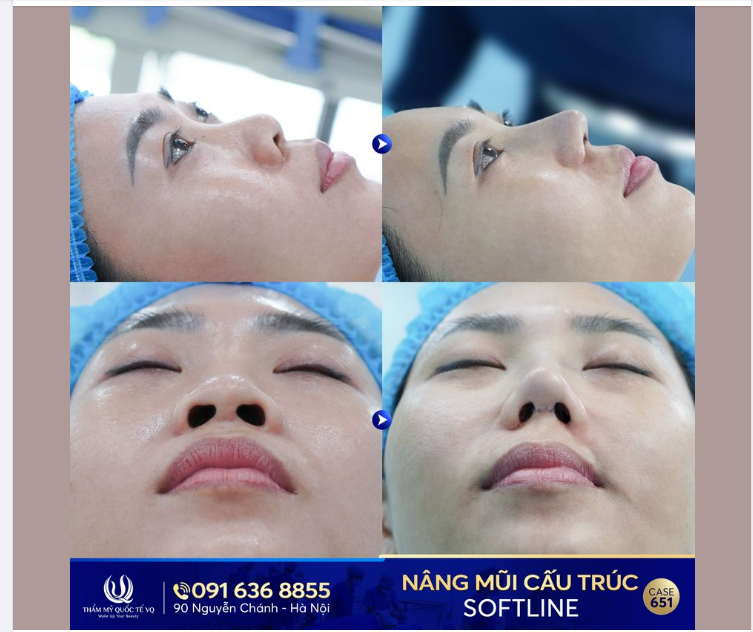 Chị K.H mất 2 năm để quyết định nâng mũi, lí do thật sự là gì