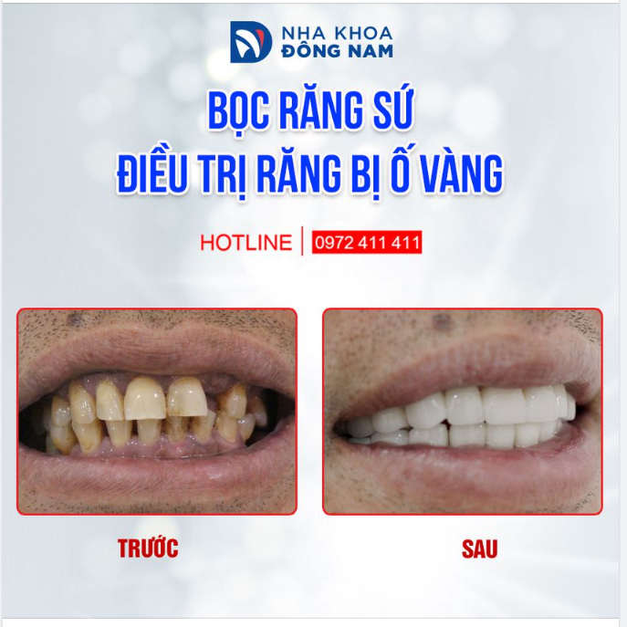 CHỈ KHI ĐẶT VÀO ĐÚNG TRƯỜNG HỢP, BẠN MỚI CẢM NHẬN ĐƯỢC HẾT NHỮNG LỢI ÍCH MÀ BỌC RĂNG SỨ MANG LẠI