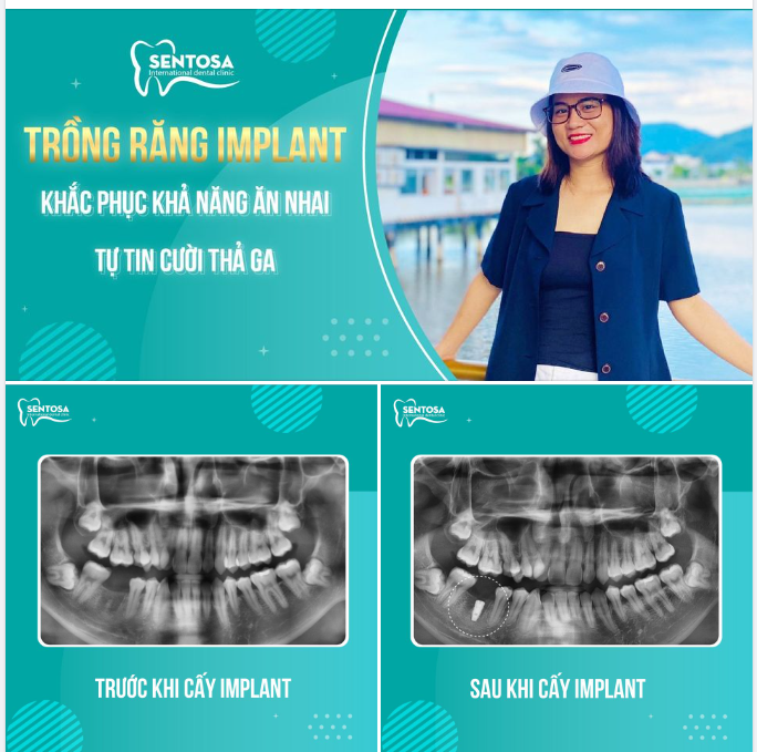 Chị Mỹ H - Sinh sống tại Đà Nẵng, đã hoàn thành quá trình trồng răng IMPLANT tại Sentosa.