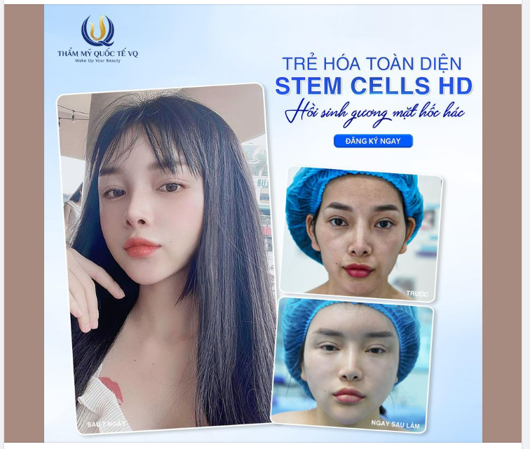 Chia sẻ của bạn Mỹ Linh, 26 tuổi sau khi thực hiện Siêu trẻ hoá Stem Cells HD.