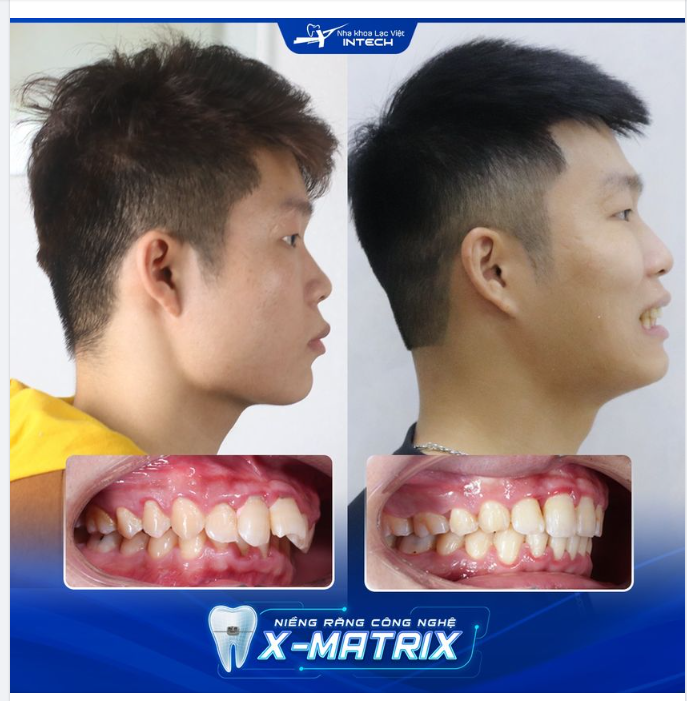 CHIA TAY RĂNG HÔ, CƯỜI TỰ TIN NHỜ NIỀNG RĂNG CÔNG NGHỆ X-MATRIX