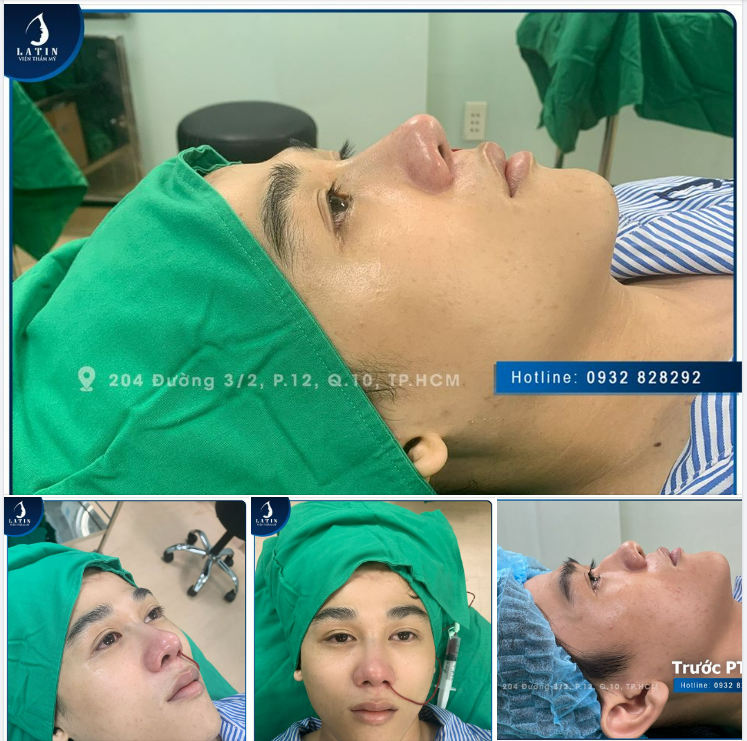 Chiếc mũi gồ với phong thủy không tốt khiến bạn nam gặp không ít khó khăn trong cuộc sống.