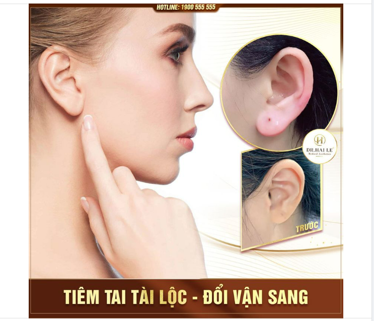 Chiêu tài lộc, đem tới sự may mắn, thịnh vượng ngay sau khi tiêm FILLER TAI