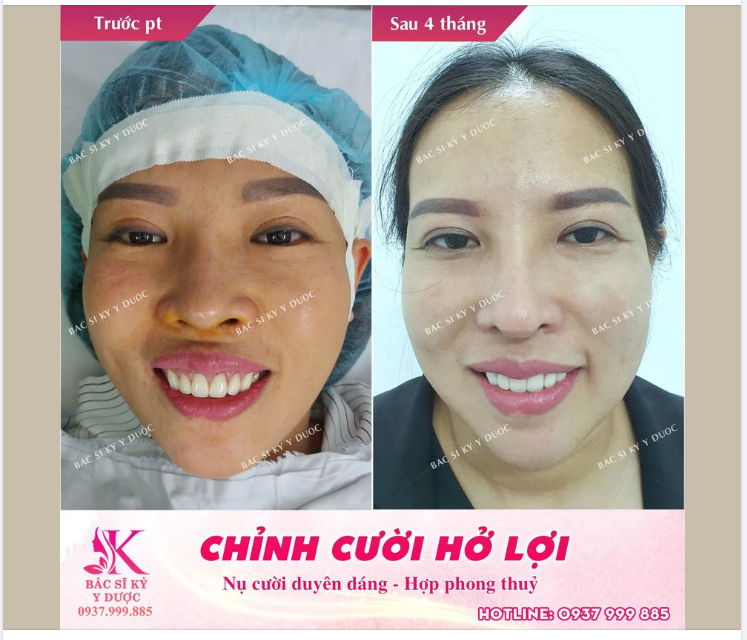CHỈNH CƯỜI HỞ LỢI - TẠO NỤ CƯỜI DUYÊN DÁNG