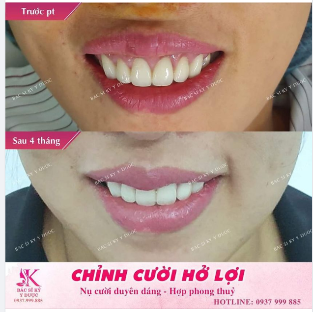 CHỈNH CƯỜI HỞ LỢI - TẠO NỤ CƯỜI DUYÊN DÁNG