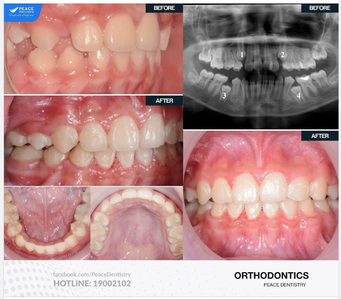 Chỉnh nha mắc cài kim loại tự đóng cho bé tuổi teen với 4 răng mọc ngầm (Tháo mắc cài sau 18 tháng)