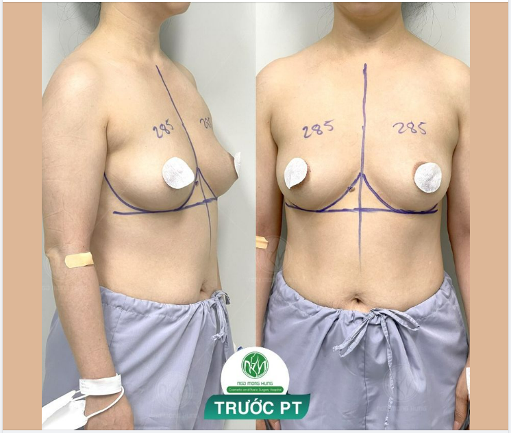 CHUẨN BỊ CHO CA NÂNG NGỰC 285cc