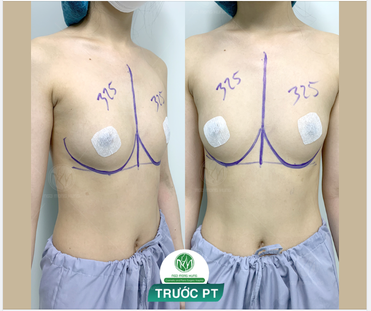 CHUẨN BỊ CHO MỘT CA NÂNG NGỰC NHỎ CHO KH