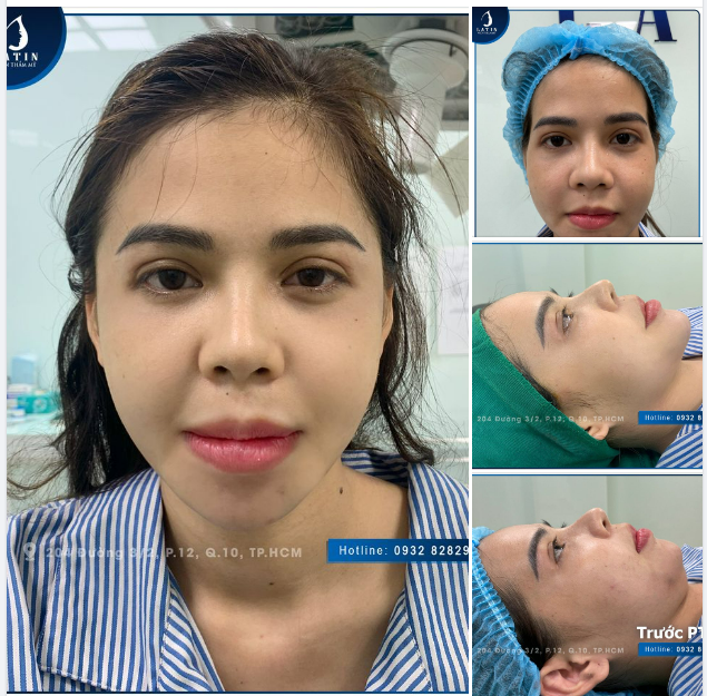 Có chị em nào thái dương lõm hóp, khiến cho khuôn mặt già trước tuổi không ạ