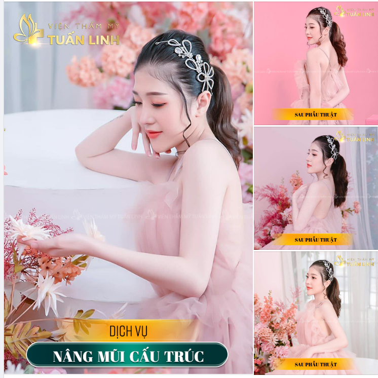 Cô nàng D.H chọn nâng mũi để xinh đẹp và tự tin hơn...!