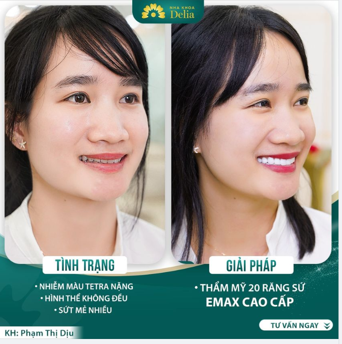 Cô nàng phiên dịch viên thay đổi nụ cười nhờ thẩm mỹ răng sứ 