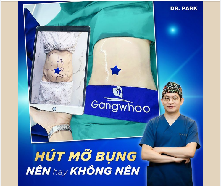 CÓ NÊN HÚT MỠ BỤNG HAY KHÔNG