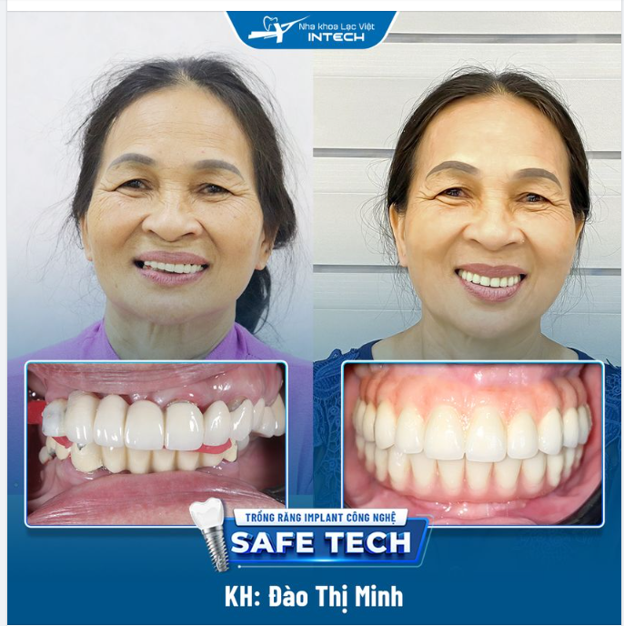 CÔ TRỒNG RĂNG XONG CẢM GIÁC MÌNH TRẺ KHỎE RA 10 TUỔI…