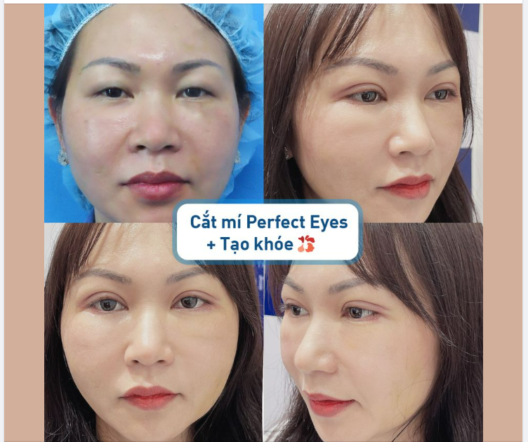 Combo Cắt mí Perfect Eyes + Tạo khóe