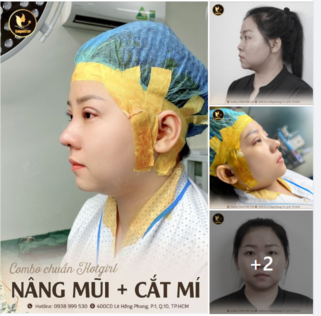 COMBO CHUẨN HOTGIRL NÂNG MŨI + CẮT MÍ