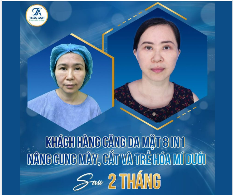 Combo giúp khách hàng ở độ tuổi 35-40 lấy lại 10 năm thanh xuân. Kết quả sau 2 tháng đẹp, ổn định, không hề có dấu vết thẩm mỹ.