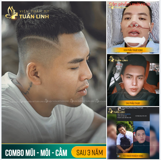 COMBO NÂNG MŨI + ĐỘN CẰM + TẠO HÌNH MÔI SAU 3 NĂM.