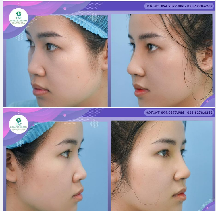 Combo phẫu thuật mài gù mũi và nâng mũi sụn nhân tạo kèm với bọc đầu mũi bằng sụn tự thân sẽ giúp tạo nên đầu mũi thon hơn, cao hơn nhưng vẫn đảm bảo được sự tự nhiên, thanh thoát.