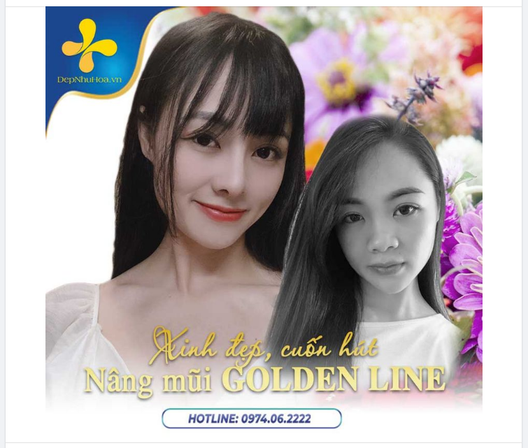 Công nghệ nâng mũi Golden Line - Bí kíp tạo nên chiếc mũi cao, đẹp ở mọi góc nhìn