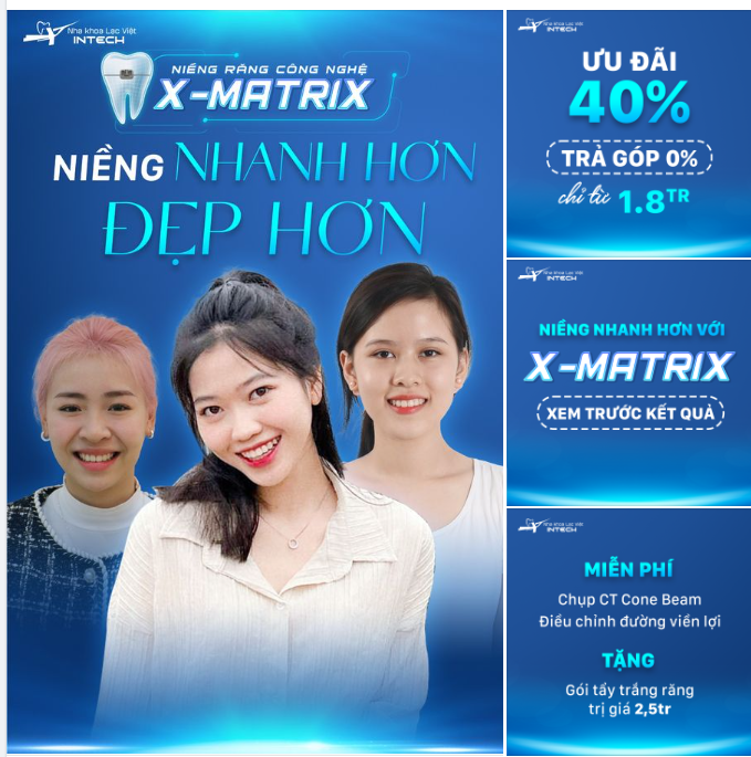 Công nghệ X-Matrix -  Niềng răng đẹp sớm, ngại gì không thử?