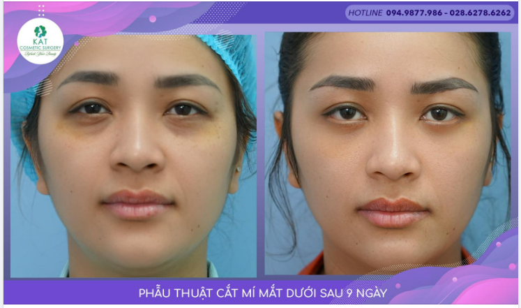 Cùng KAT gác lại hết âu lo bằng cách xoá tan bọng mắt dưới nhé