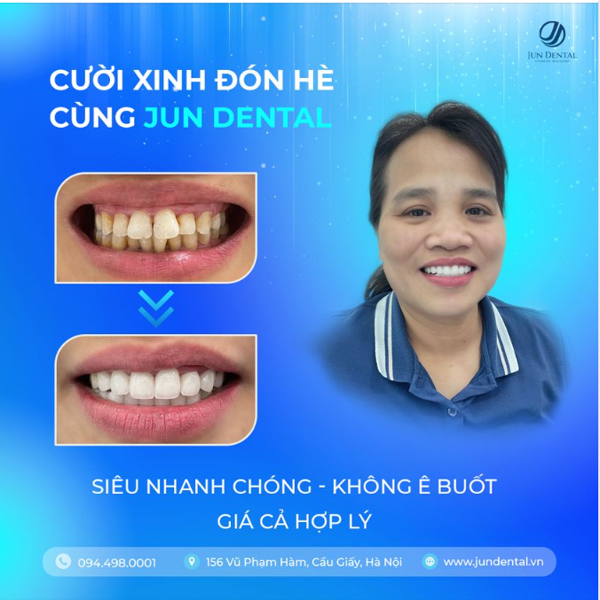 CƯỜI XINH ĐÓN HÈ CÙNG JUN DENTAL 