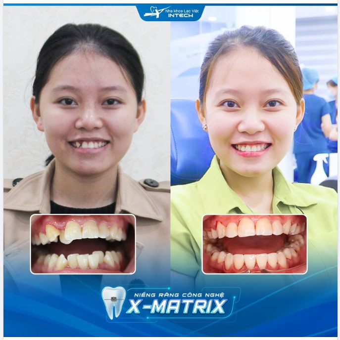 DÀN ĐỀU KHẤP KHỂNH – TỰ TIN VỚI NỤ CƯỜI XINH