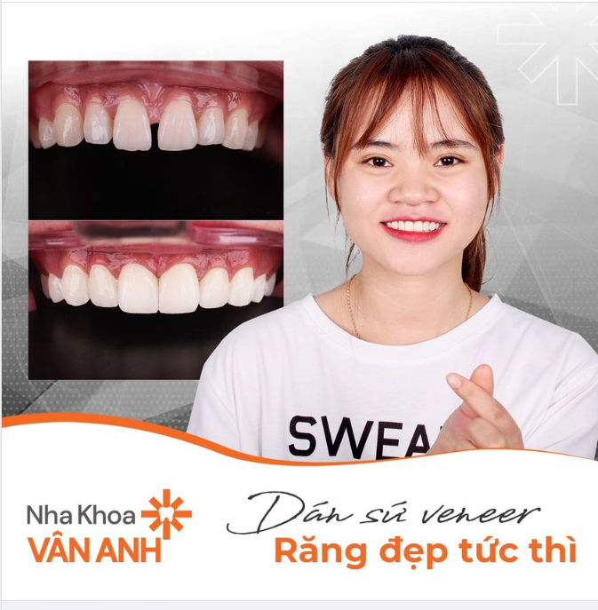 DÁN SỨ VENEER - RĂNG ĐẸP TỨC THÌ
