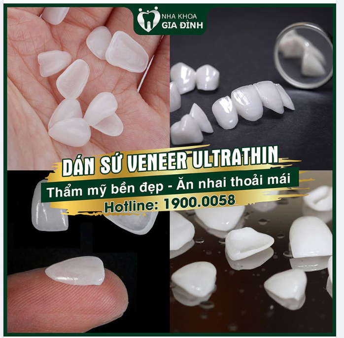 DÁN SỨ VENEER ULTRATHIN: BỀN ĐẸP, CHẮC KHỎE - ĂN NHAI THOẢI MÁI