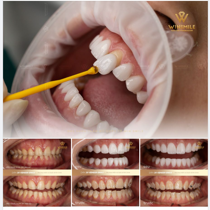 DÁN SỨ VENEER - XU THẾ LÀM ĐẸP AN TOÀN, KHÔNG MÀI RĂNG
