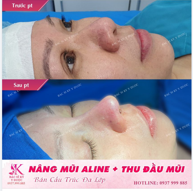 DÁNG MŨI ALINE CẤU TRÚC + THU NHỎ ĐẦU MŨI NÂNG TẦM VẺ ĐẸP CHO BẠN GÁI