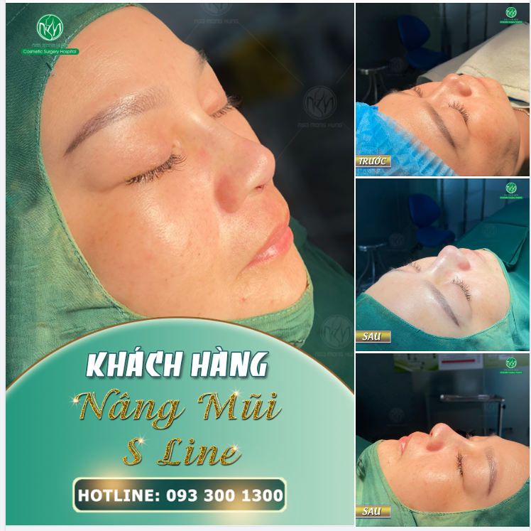 DÁNG MŨI ĐẸP CHO KH TUỔI TRUNG NIÊN