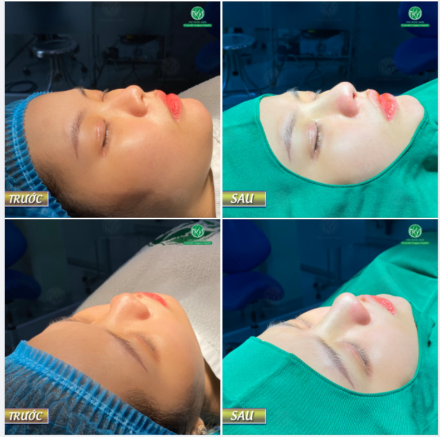DÁNG MŨI ĐƯỢC NHIỀU CHỊ EM YÊU THÍCH TẠI BỆNH VIỆN