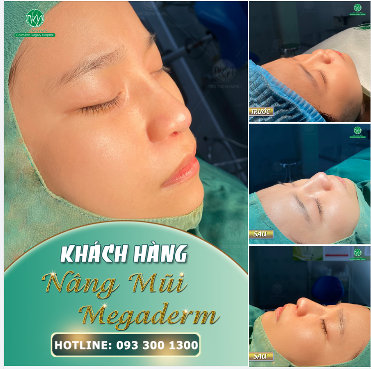 DÁNG MŨI ĐƯỢC NHIỀU KHÁCH HÀNG LỰA CHỌN