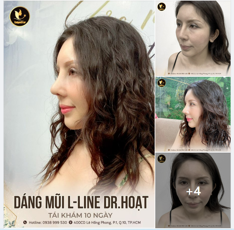 Dáng mũi L-line chưa chắc đẹp, dáng mũi cao tây chưa chắc đẹp