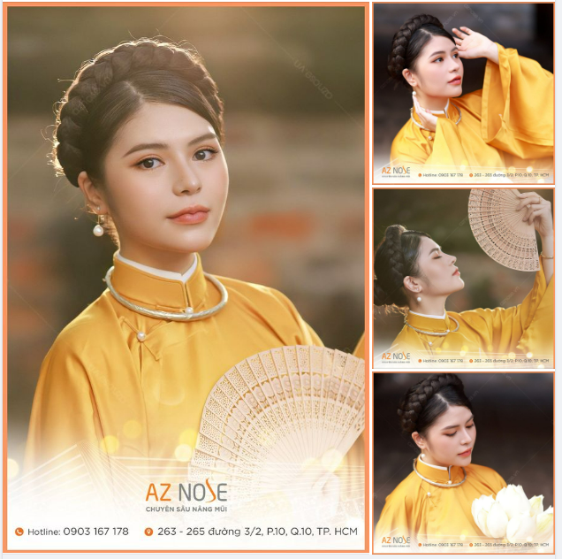 Dáng mũi Sline sau 1 năm nâng cấu trúc sụn tai