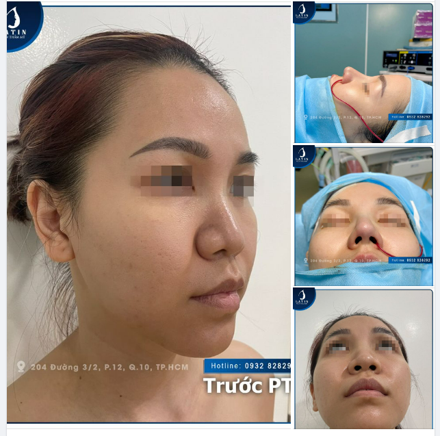 Dáng mũi theo yêu cầu của khách hàng với phương pháp nâng mũi bán cấu trúc tại Latin