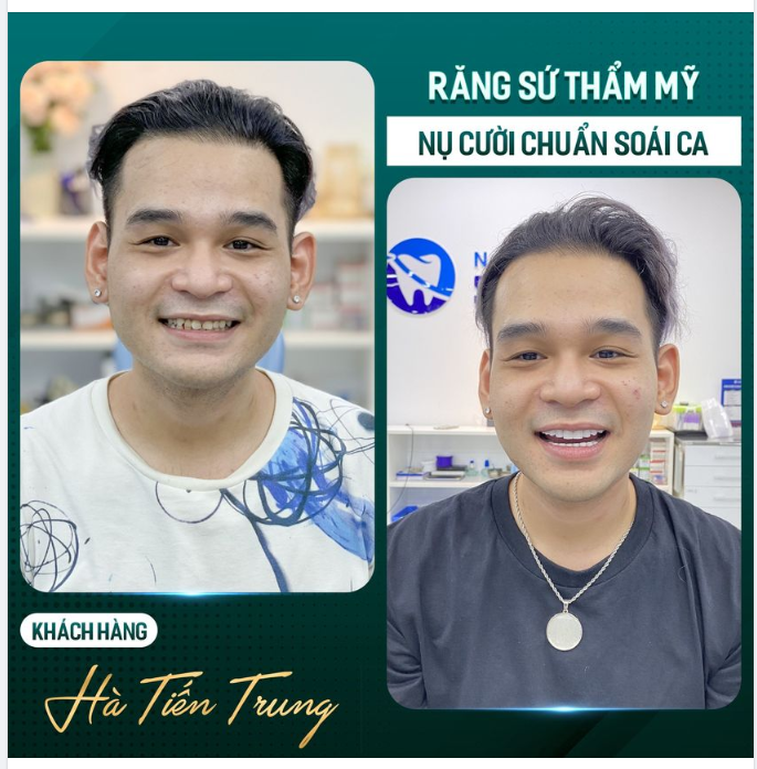 Đánh bay nụ cười kém duyên chỉ sau 2 lần hẹn tại Sunshine
