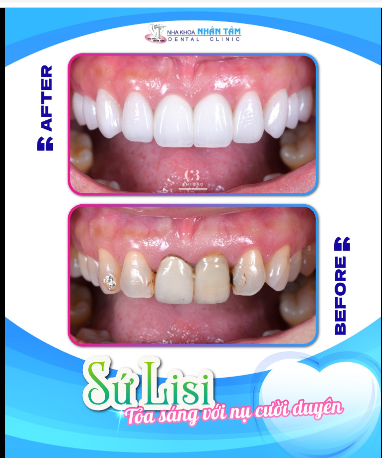 ĐÂY LÀ LÝ DO BẠN NÊN LỰA CHỌN SỨ THẨM MỸ LISI