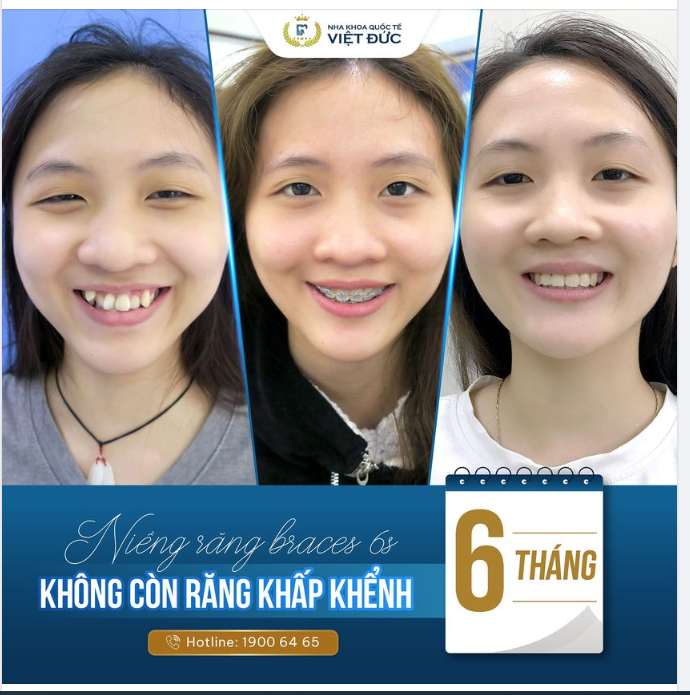 ĐẨY LÙI NỖI LO RĂNG KHẤP KHỂNH