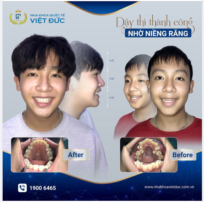 DẬY THÌ THÀNH CÔNG NHỜ…NIỀNG RĂNG