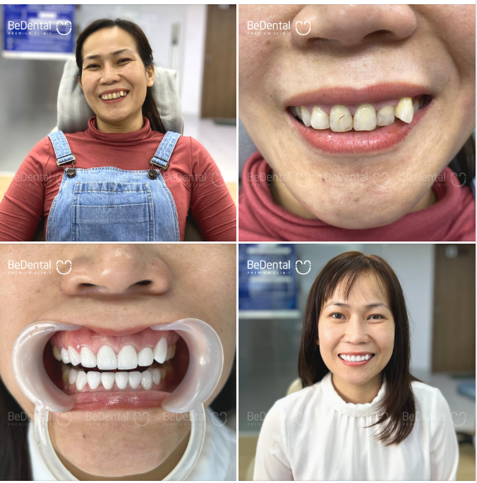 Đến Bedental thẩm mỹ răng sứ vẫn giữ nguyên nét khểnh duyên
