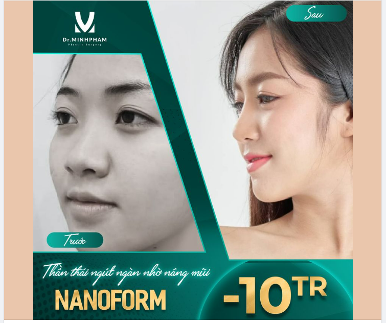 “ĐẾN LÀ ĐẸP” - CHỈ SAU 45H NÂNG MŨI NANOFORM!