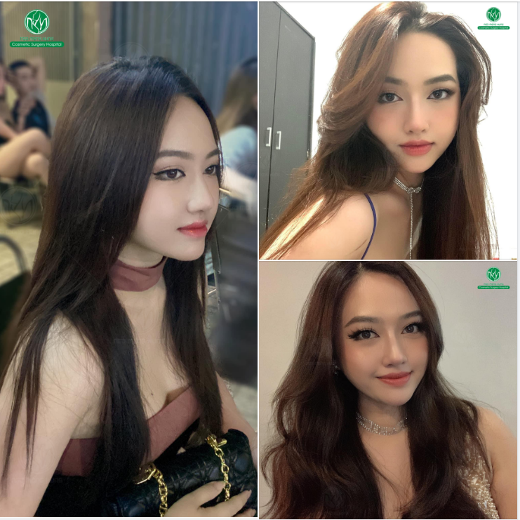 ĐẸP CHUẨN NÀNG THƠ VỚI DÁNG MŨI MEGADERM
