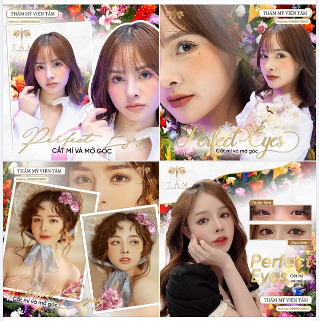 Đẹp như nàng thơ nhờ Combo Cắt mí - Mở góc Perfect Eyes