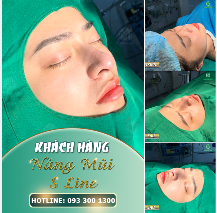 ĐẸP RẠNG NGỜI VỚI DÁNG MŨI S LINE