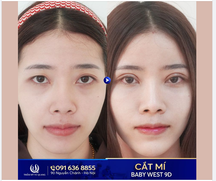 Đi tìm hiểu và nghe review về cắt mí của Thẩm mỹ Vũ Quang qua các hội nhóm rất nhiều rồi mới dám làm. Thực sự kết quả hơn cả sự mong chờ của mình, thực sự đẹp